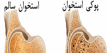 «شکستگی‌ مرضی» چیست؟