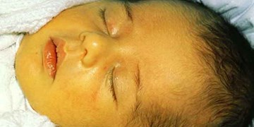 «زردی» بیش از 20 درصد در کودکان باعث آسیب «مغز» می‌شود