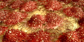نحوه نجات سلول های ایمنی در زمان تهاجم سرطان آشکار شد