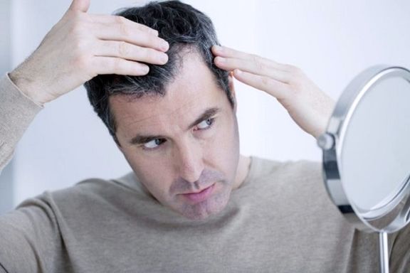 وقتی ژنتیک نقشی در ریزش مو ندارد