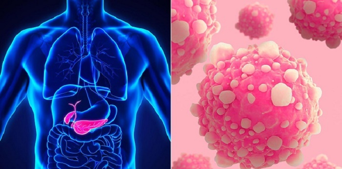 سرطان پانکراس چیست؟؛ علت، علائم و راه های درمان