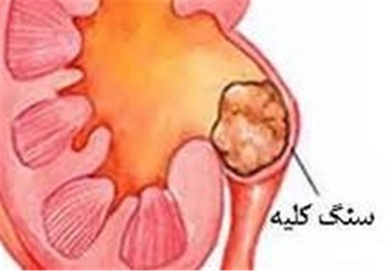 همه چیز درباره سنگ کلیه