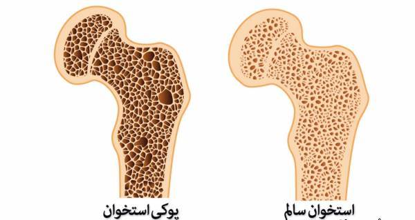 تاثیر داروهای پوکی استخوان بر کاهش خطر مرگ و میر